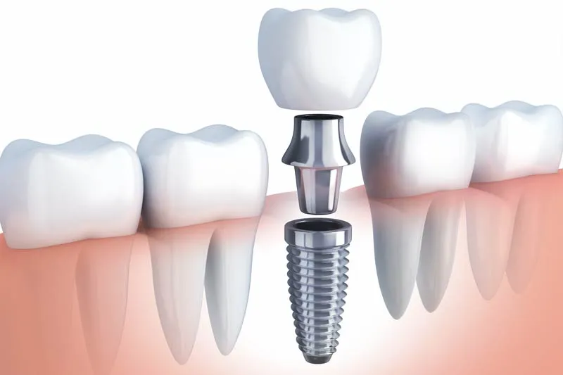 Dental Implants at Astra Dental