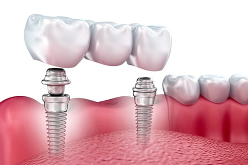 Dental implant care at Astra Dental