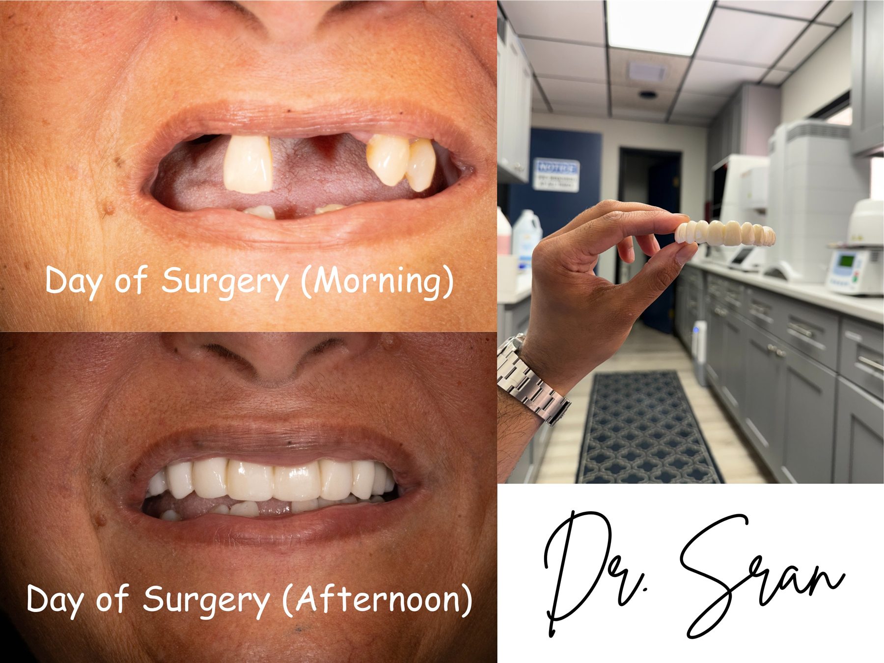 Same Day Teeth at Astra Dental