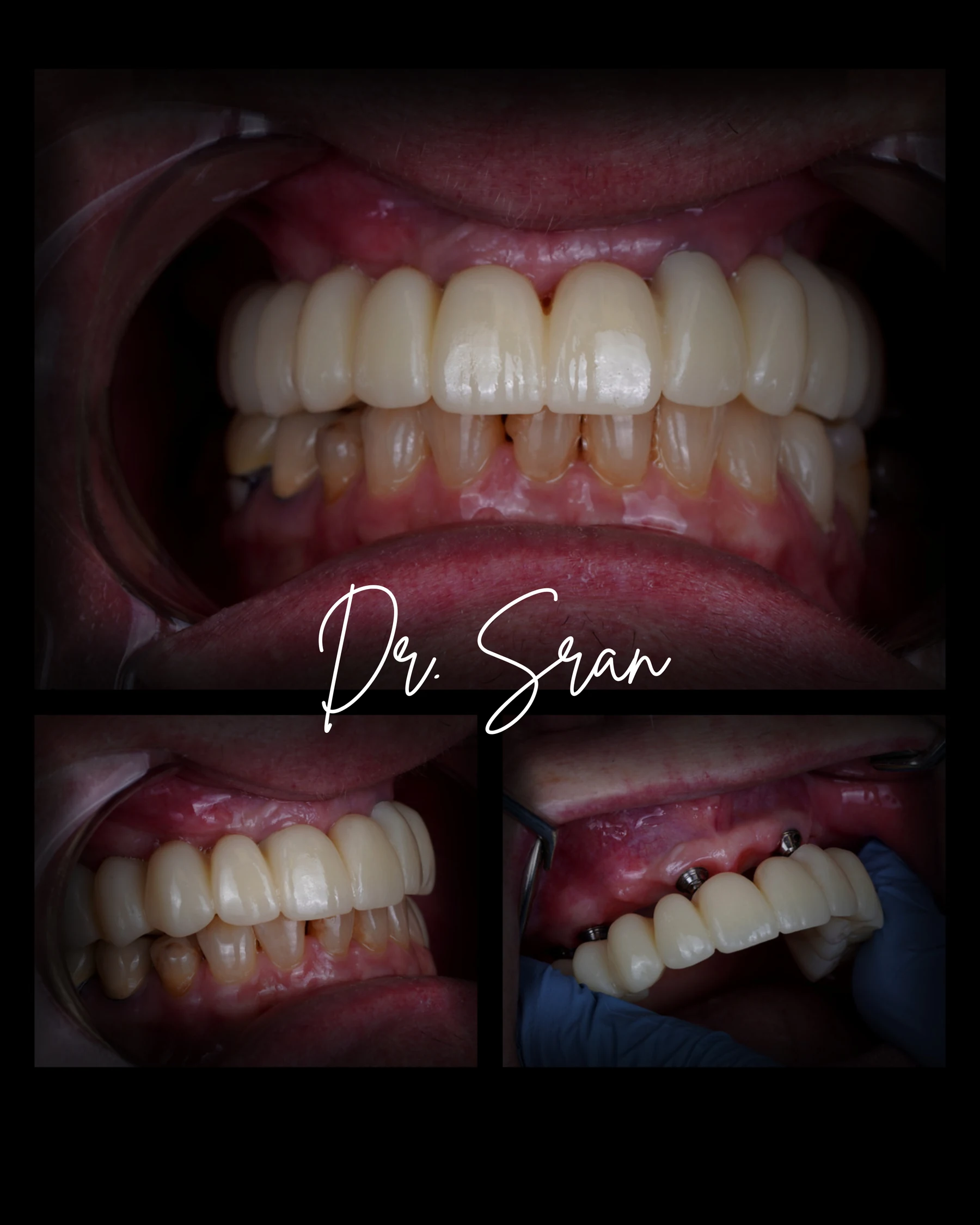 All-on-6 full-arch implant result collage by Dr. Sran at Astra Dental