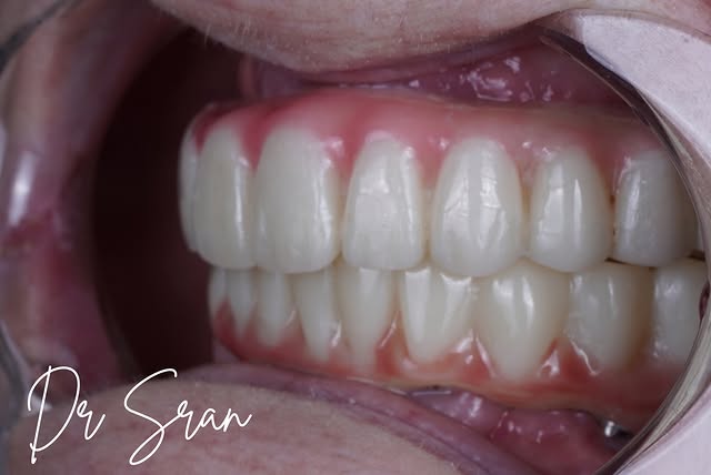 Snap-On Dentures at Astra Dental in Stratford, CT