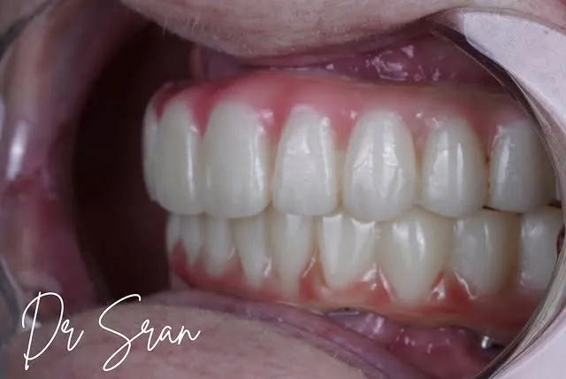 Snap-On Dentures at Astra Dental