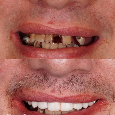 All-on-X no fake gums case by Dr. Sran at Astra Dental