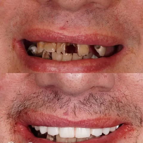 All-on-X no fake gums case by Dr. Sran at Astra Dental