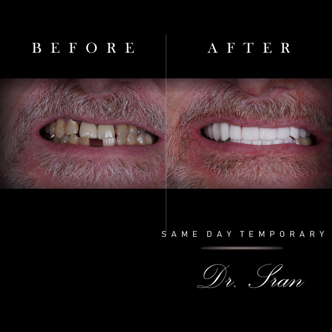 All-on-X same-day temporary before and after smile case by Dr. Sran at Astra Dental