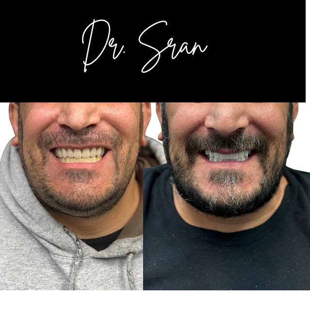 Full zirconia All-on-X smile result by Dr. Sran