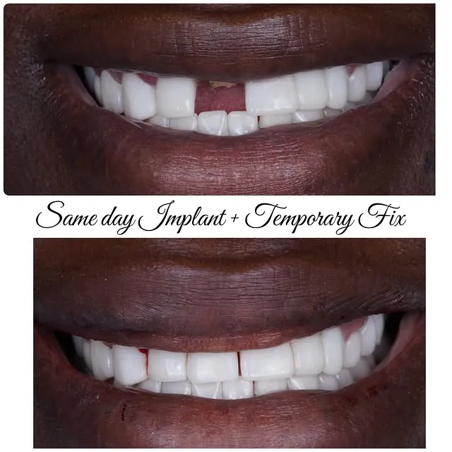 Front tooth implant temporary case by Dr. Sran at Astra Dental