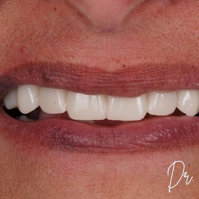 Smile design details from Dr. Sran's Instagram