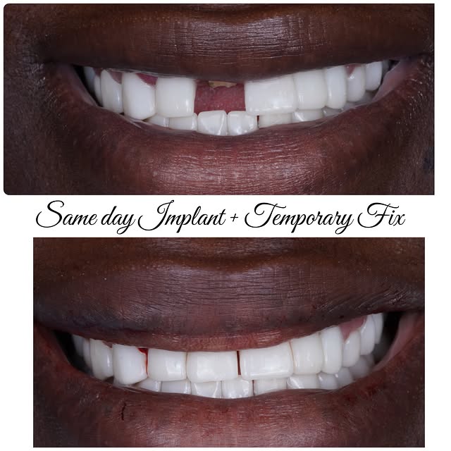 Same-day implant temp from Dr. Sran's Instagram