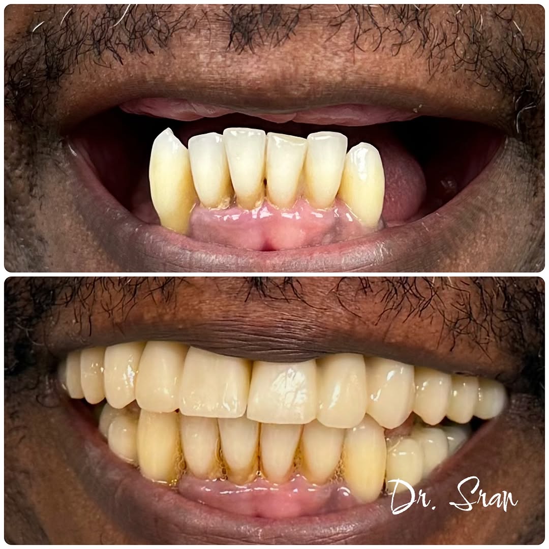 Same day teeth with six dental implants by Dr. Sran at Astra Dental