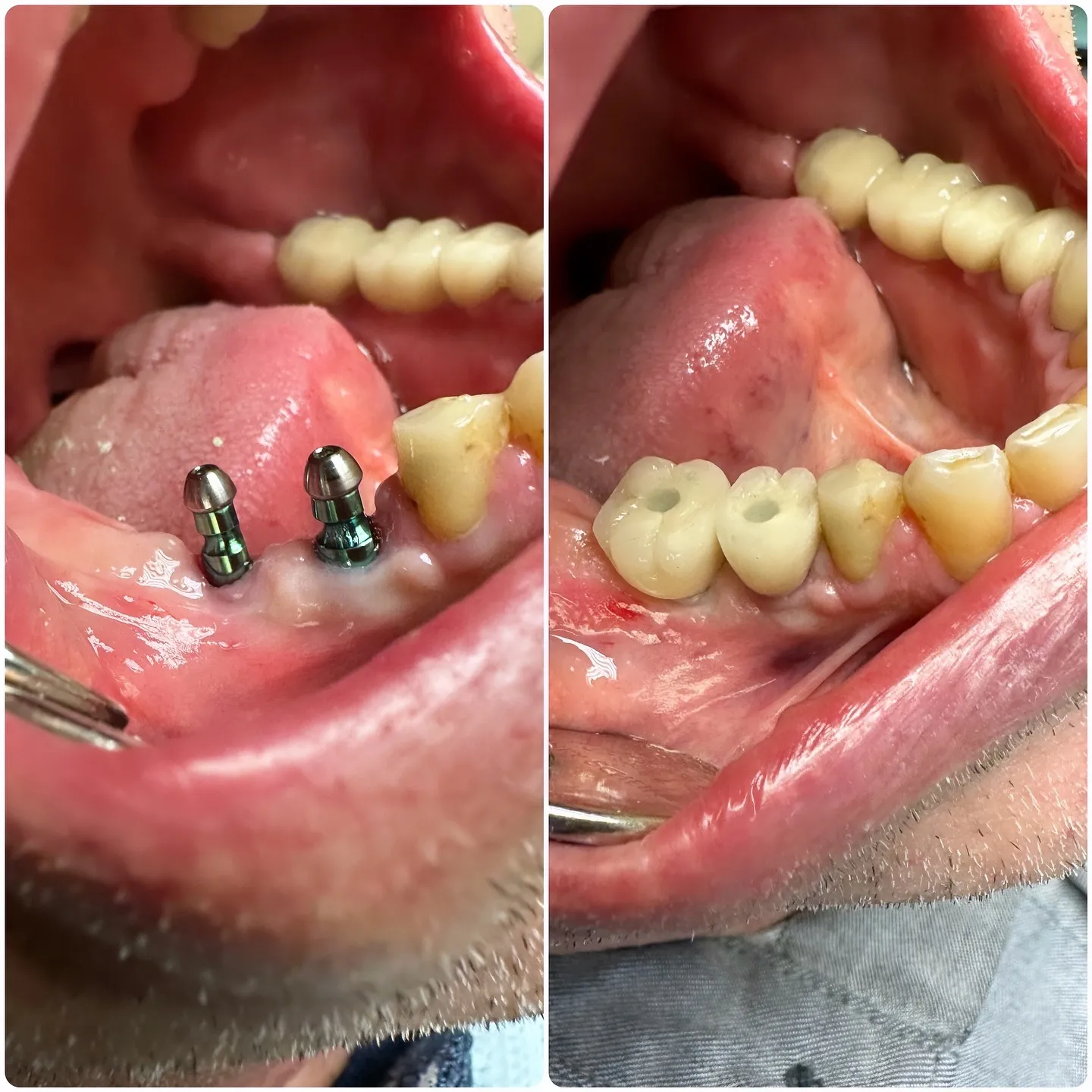 Single tooth implant crowns by Dr. Sran at Astra Dental