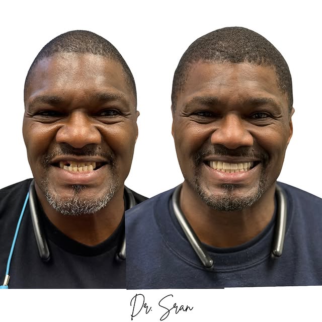 Smile transformation with six implants and sinus lifts by Dr. Sran at Astra Dental