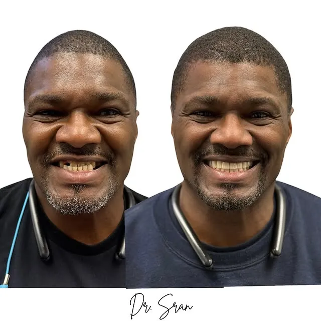 Smile transformation with six implants and sinus lifts by Dr. Sran at Astra Dental