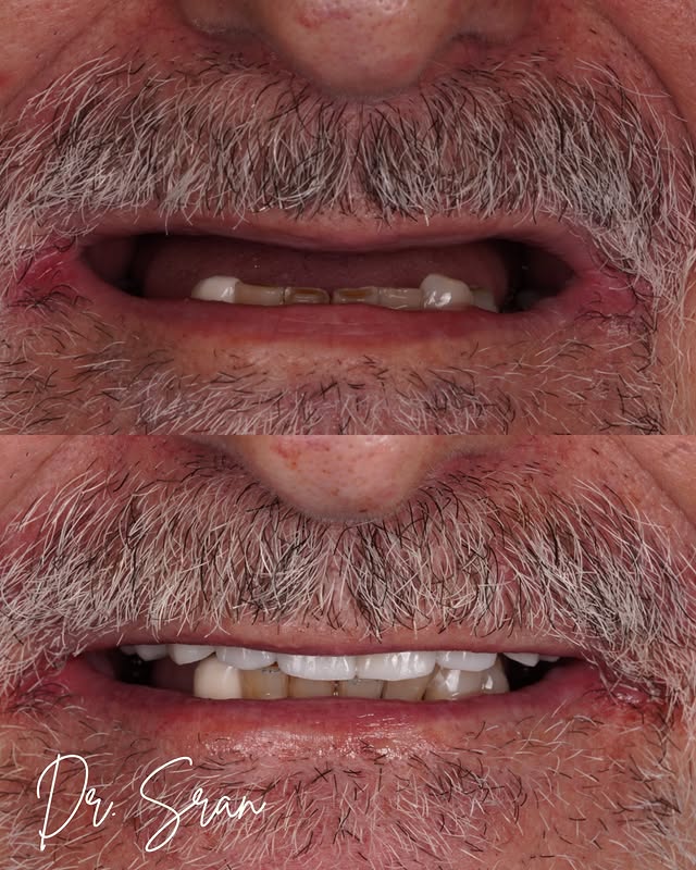 Upper All-on-X implant case by Dr. Sran at Astra Dental