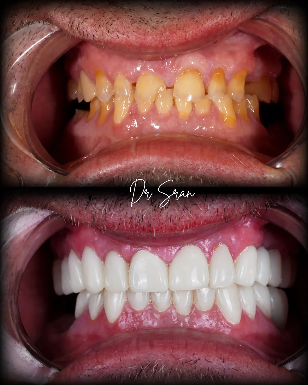 Full mouth reconstruction before and after case by Dr. Sran at Astra Dental