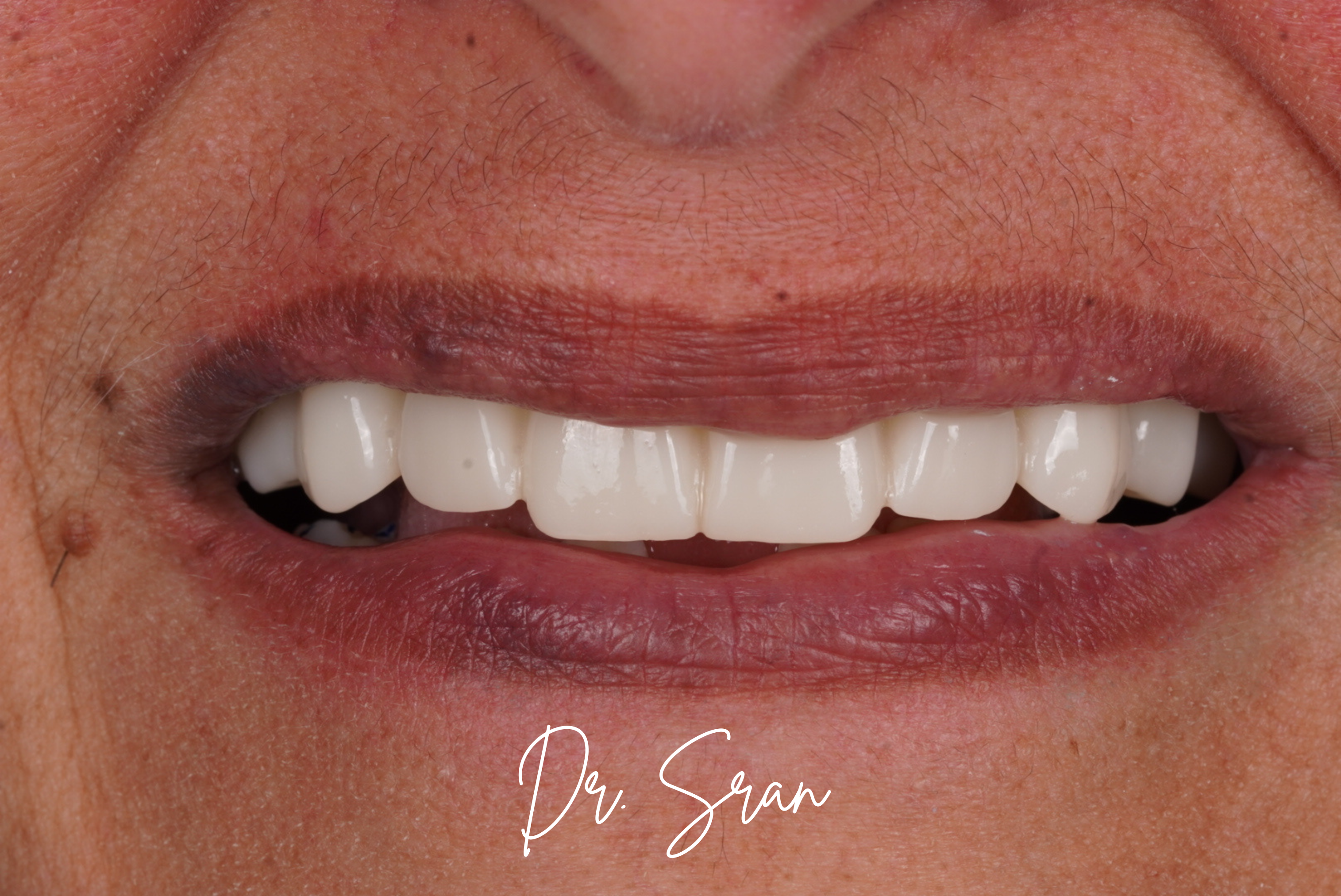 Smile result close-up by Dr. Sran