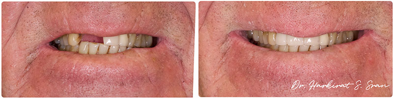 All-on-X Implants at Astra Dental