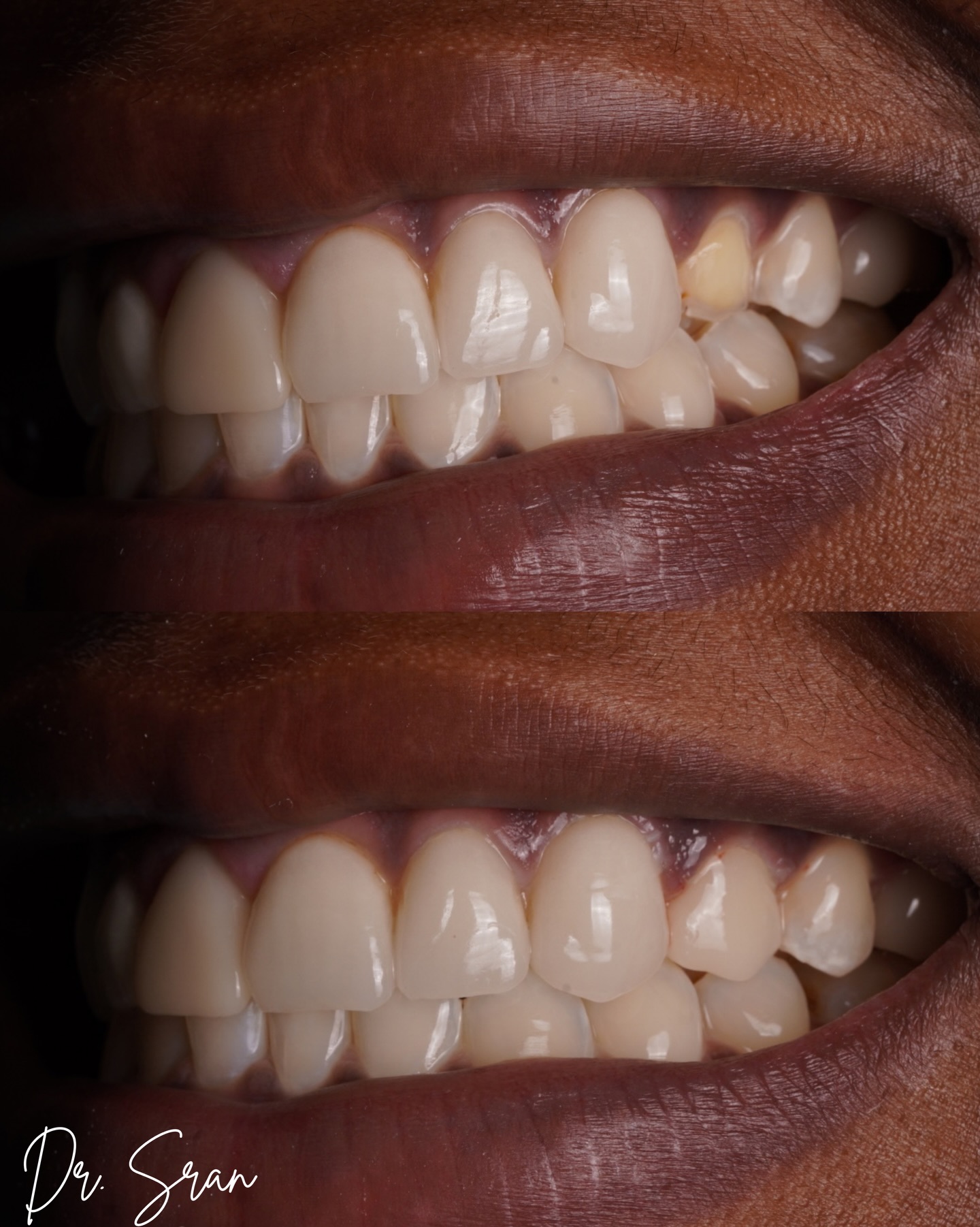 Lost veneer same-day fix case photo from Astra Dental