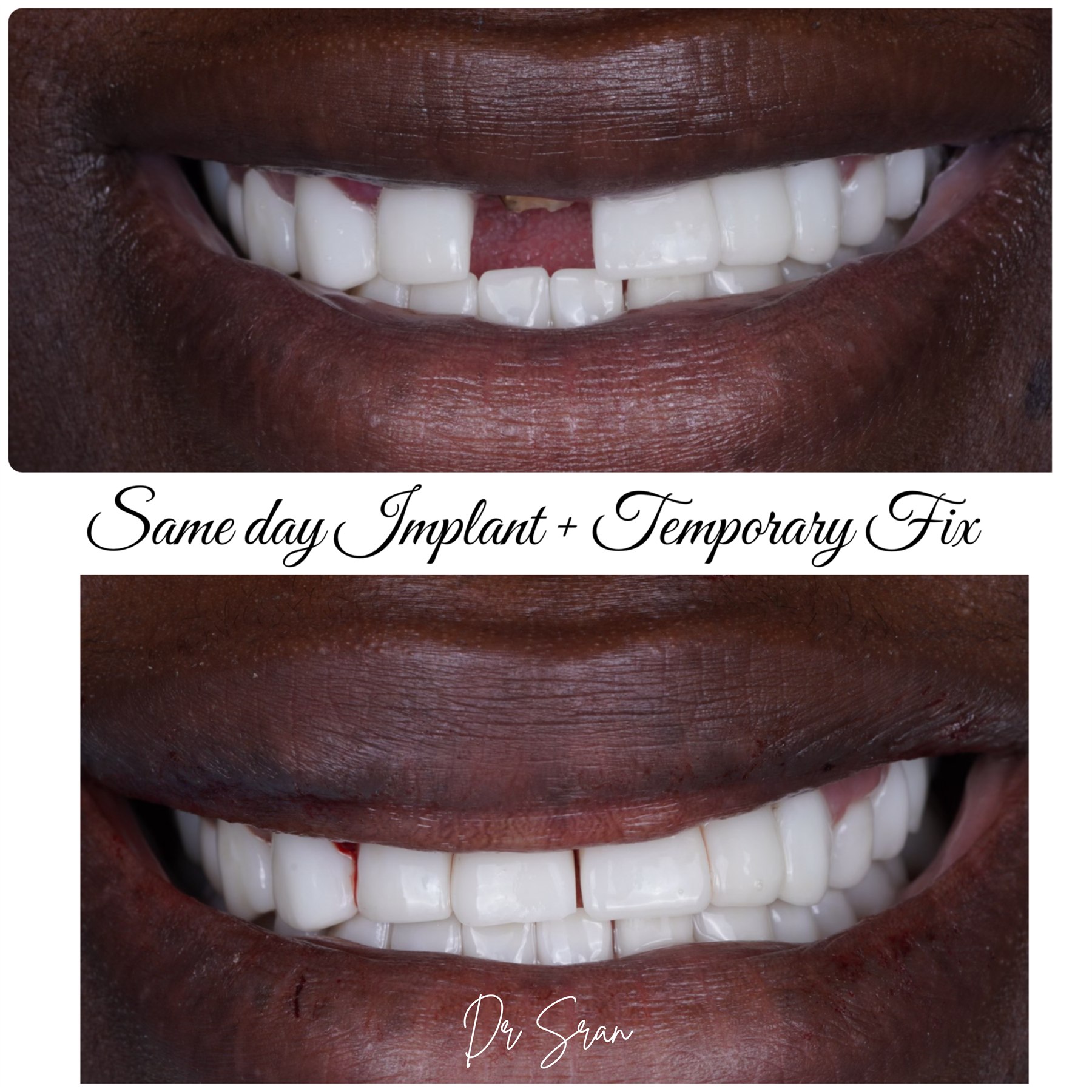 Same-day implant temp case photo from Astra Dental