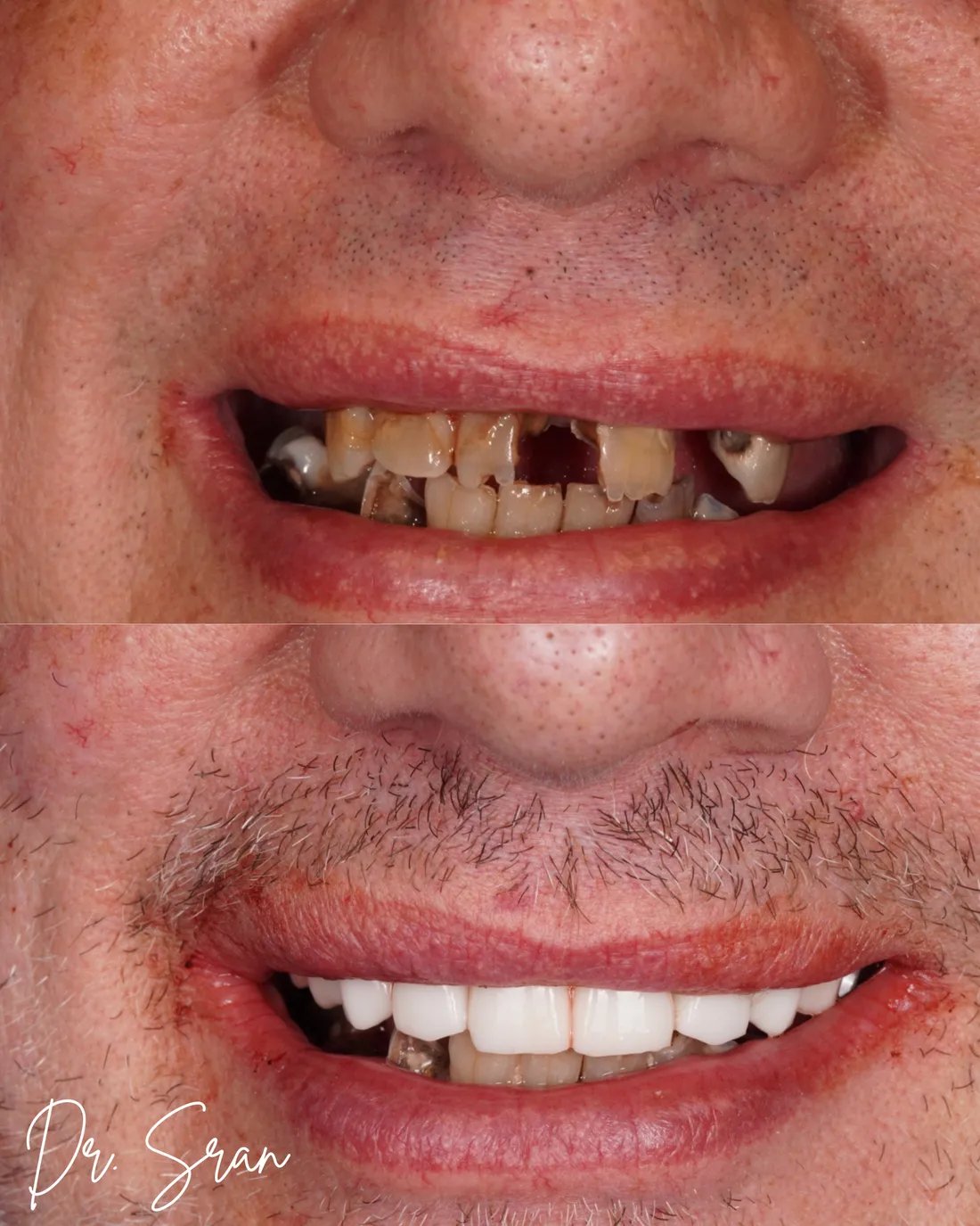 Full-arch smile rebuild case photo from Astra Dental