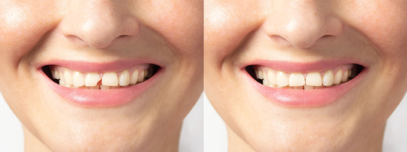 Same Day Teeth at Astra Dental