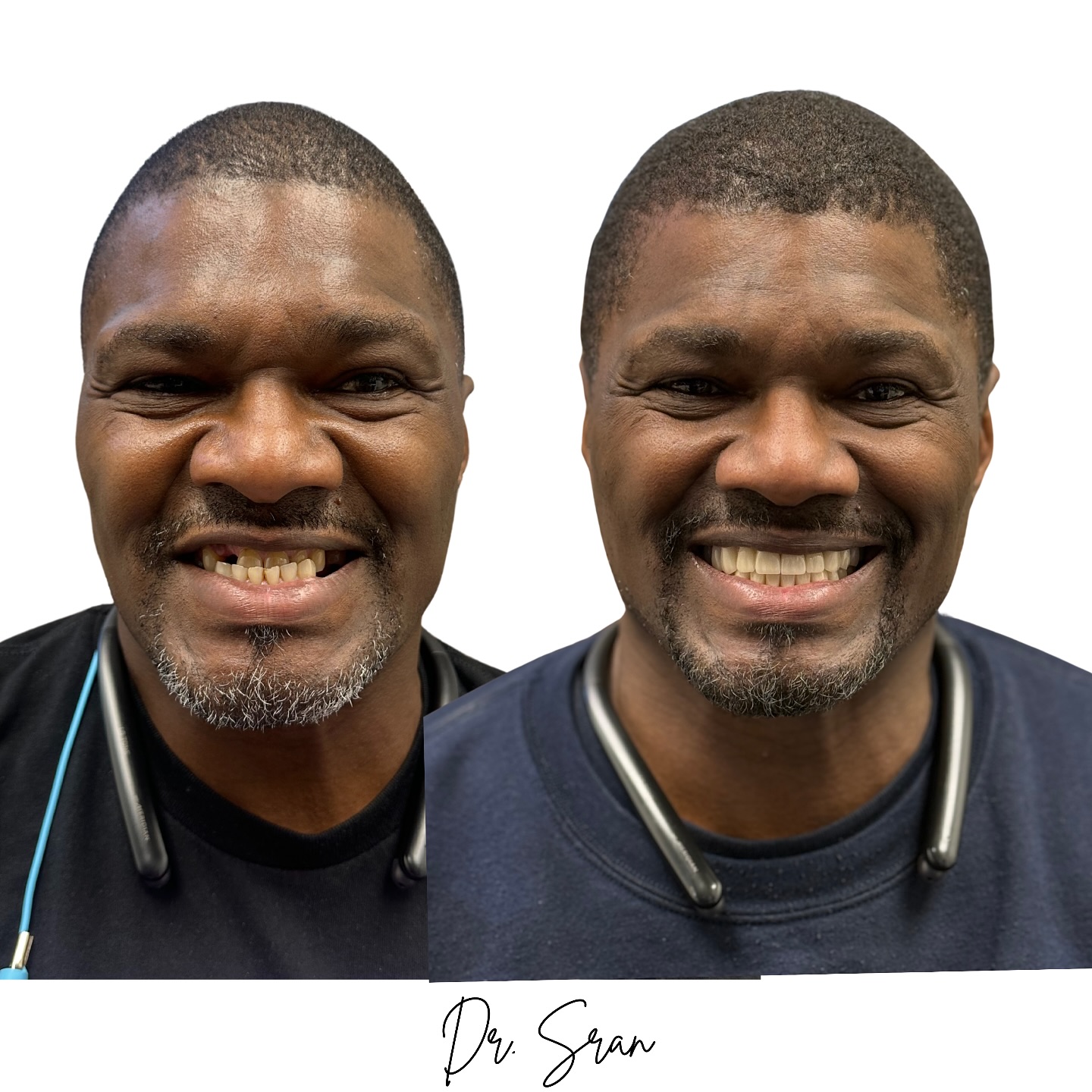 Implant zirconia transformation case photo from Astra Dental