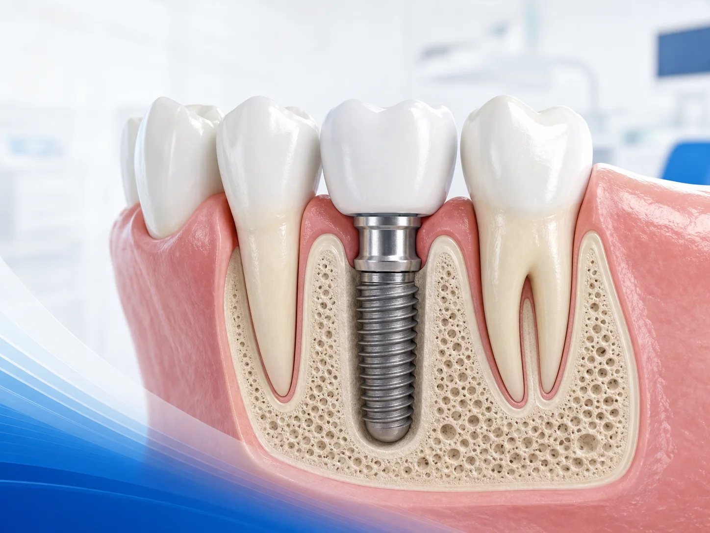 Dental implant illustration showing an implant, abutment, and crown supported by bone