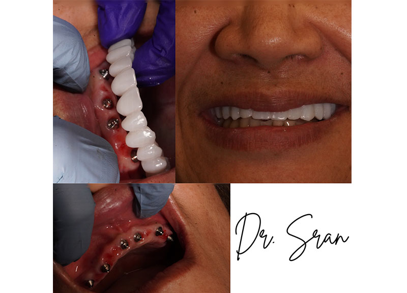 Full-Arch Implants in Stratford