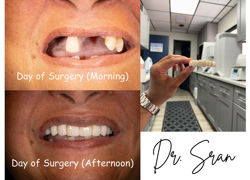 Full-Arch Implants in Stratford